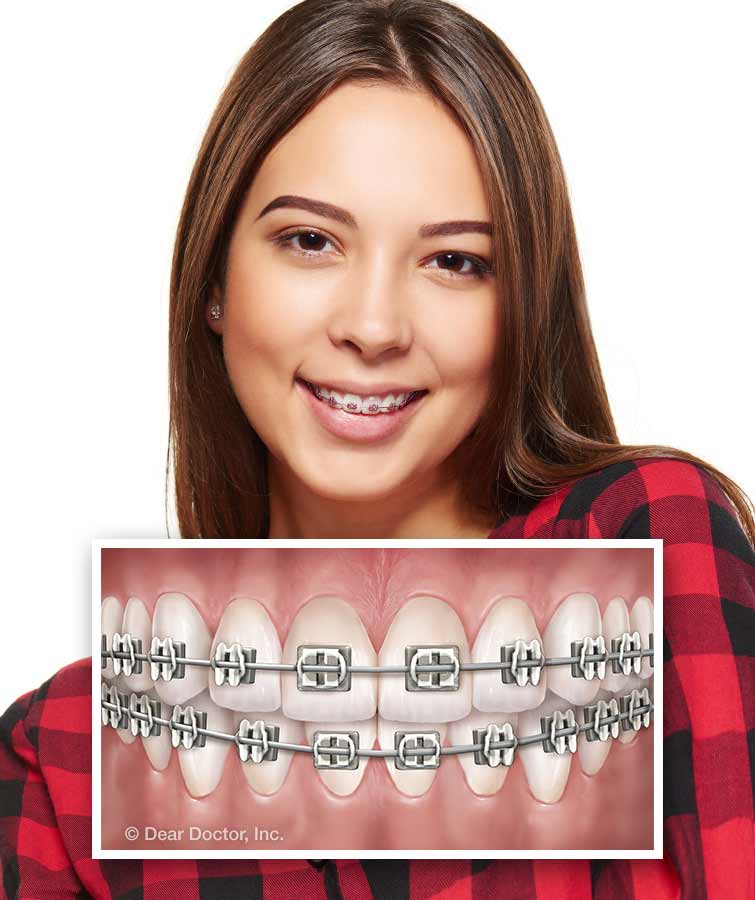 Traditional Metal Braces.